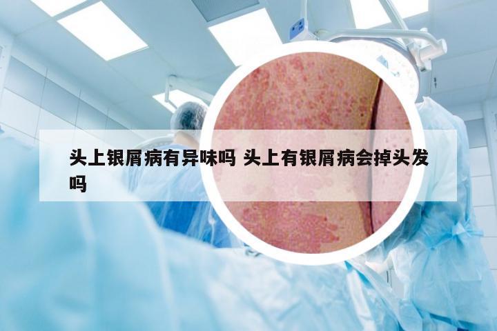 头上银屑病有异味吗 头上有银屑病会掉头发吗