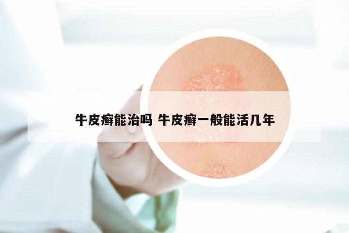 牛皮癣能治吗 牛皮癣一般能活几年
