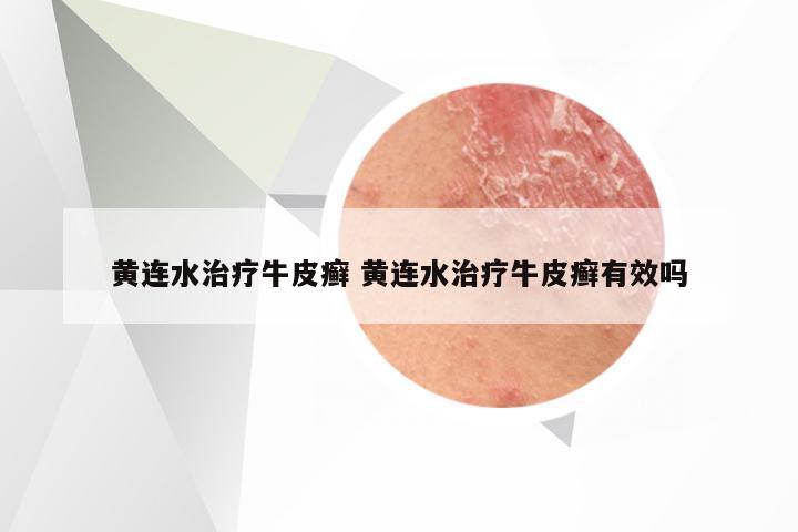 黄连水治疗牛皮癣 黄连水治疗牛皮癣有效吗