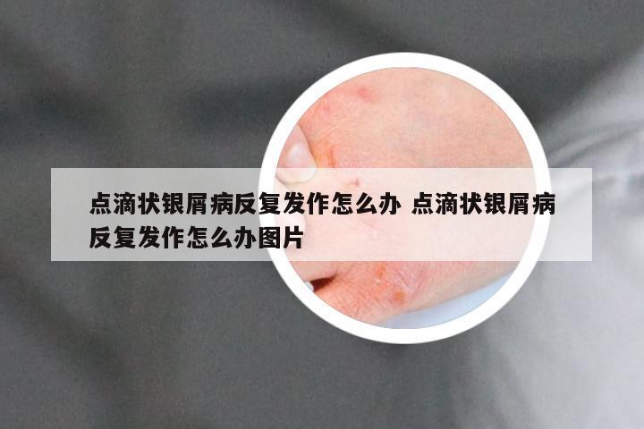 点滴状银屑病反复发作怎么办 点滴状银屑病反复发作怎么办图片