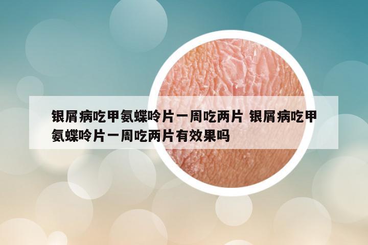 银屑病吃甲氨蝶呤片一周吃两片 银屑病吃甲氨蝶呤片一周吃两片有效果吗