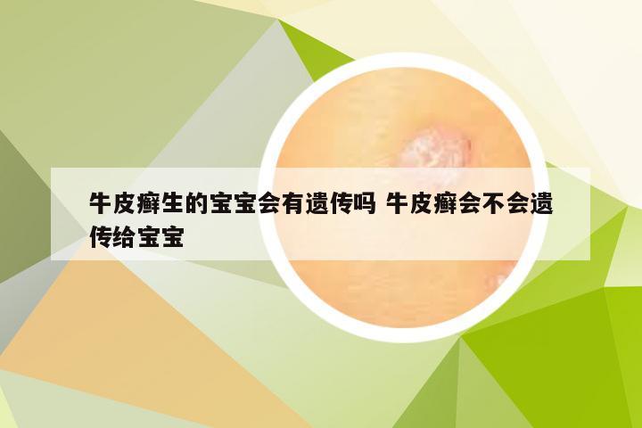 牛皮癣生的宝宝会有遗传吗 牛皮癣会不会遗传给宝宝