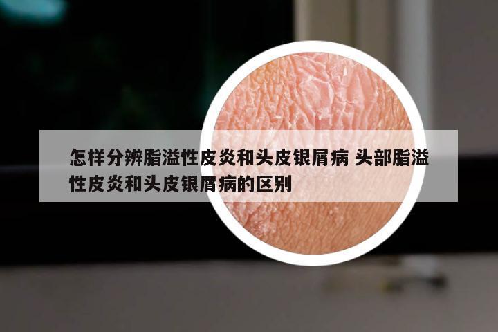 怎样分辨脂溢性皮炎和头皮银屑病 头部脂溢性皮炎和头皮银屑病的区别