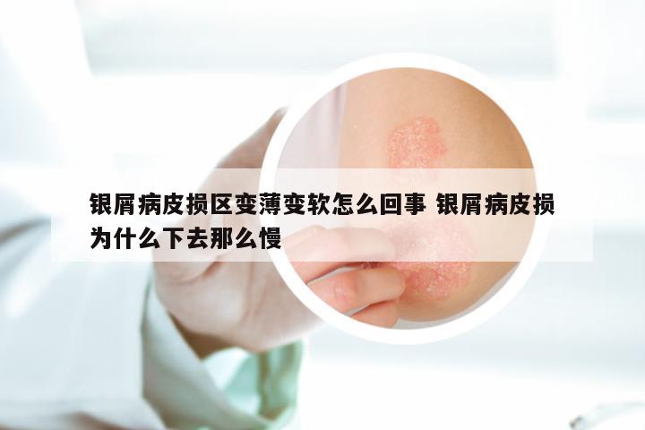 银屑病皮损区变薄变软怎么回事 银屑病皮损为什么下去那么慢
