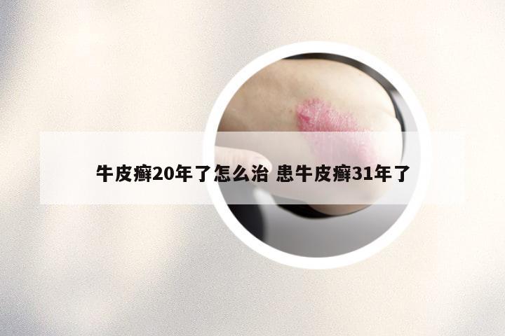 牛皮癣20年了怎么治 患牛皮癣31年了