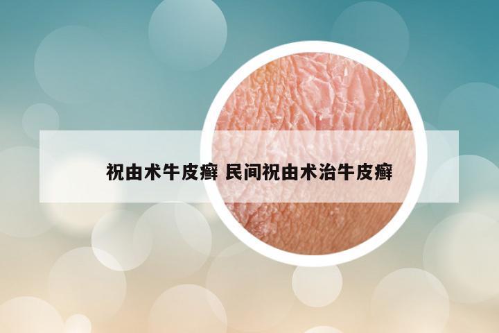 祝由术牛皮癣 民间祝由术治牛皮癣