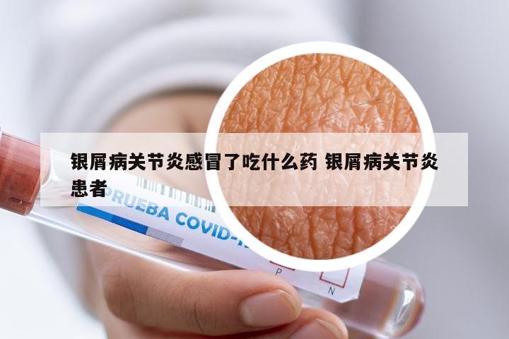 银屑病关节炎感冒了吃什么药 银屑病关节炎患者