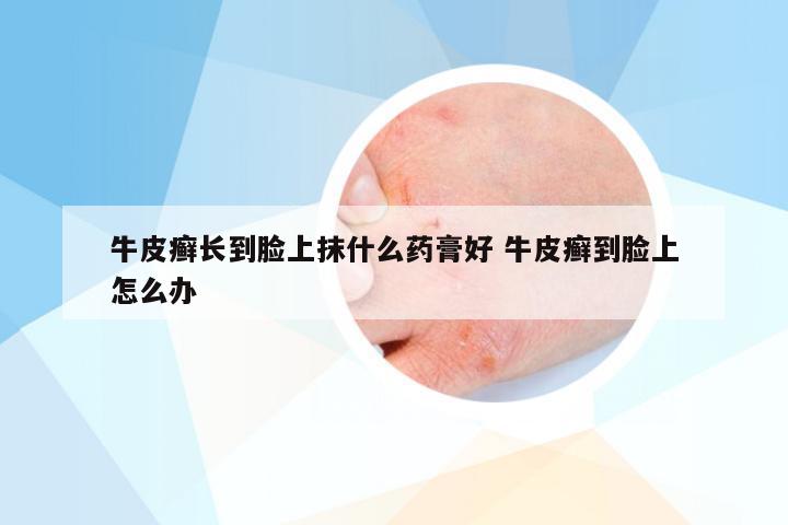 牛皮癣长到脸上抹什么药膏好 牛皮癣到脸上怎么办