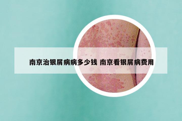 南京治银屑病病多少钱 南京看银屑病费用
