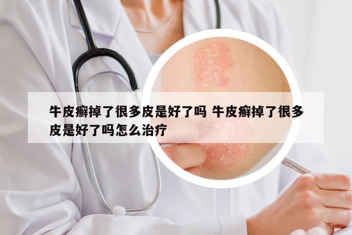 牛皮癣掉了很多皮是好了吗 牛皮癣掉了很多皮是好了吗怎么治疗