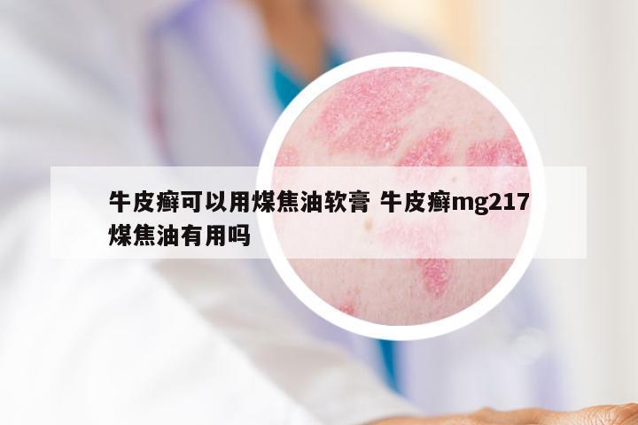 牛皮癣可以用煤焦油软膏 牛皮癣mg217煤焦油有用吗