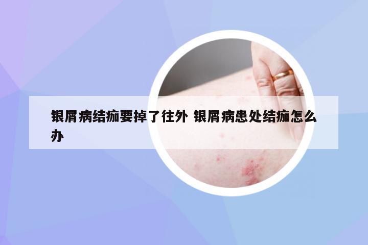 银屑病结痂要掉了往外 银屑病患处结痂怎么办