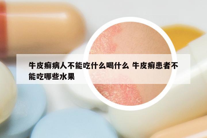 牛皮癣病人不能吃什么喝什么 牛皮癣患者不能吃哪些水果