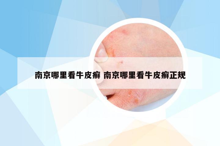 南京哪里看牛皮癣 南京哪里看牛皮癣正规