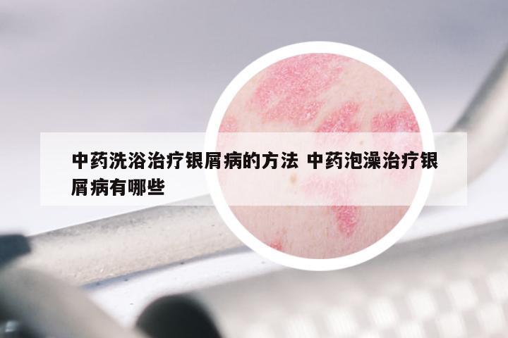 中药洗浴治疗银屑病的方法 中药泡澡治疗银屑病有哪些