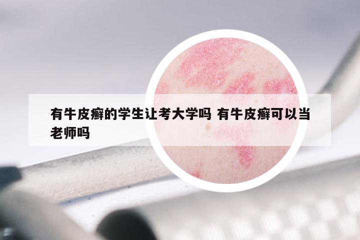 有牛皮癣的学生让考大学吗 有牛皮癣可以当老师吗