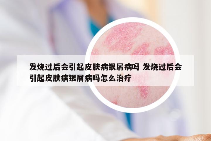 发烧过后会引起皮肤病银屑病吗 发烧过后会引起皮肤病银屑病吗怎么治疗