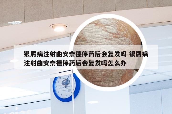 银屑病注射曲安奈德停药后会复发吗 银屑病注射曲安奈德停药后会复发吗怎么办