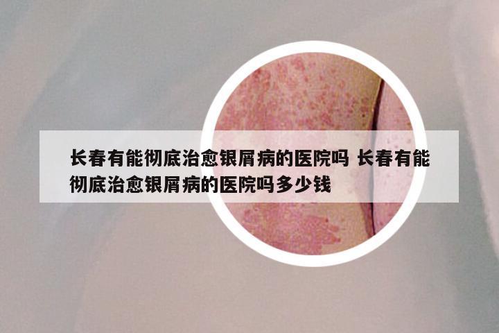 长春有能彻底治愈银屑病的医院吗 长春有能彻底治愈银屑病的医院吗多少钱