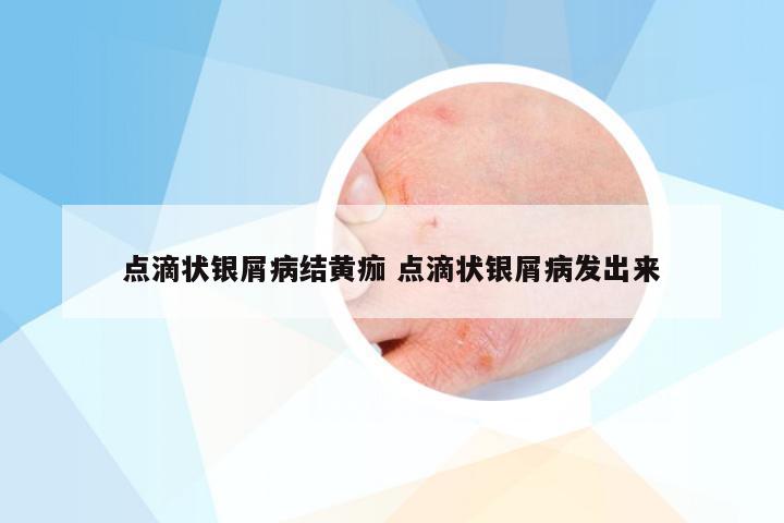 点滴状银屑病结黄痂 点滴状银屑病发出来