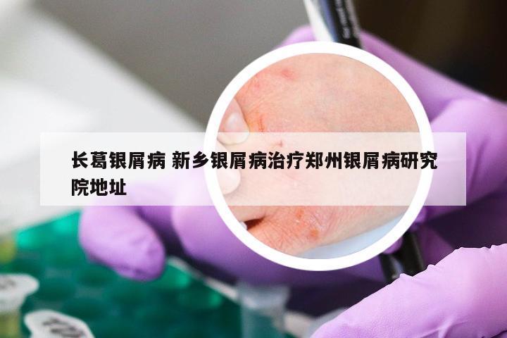 长葛银屑病 新乡银屑病治疗郑州银屑病研究院地址