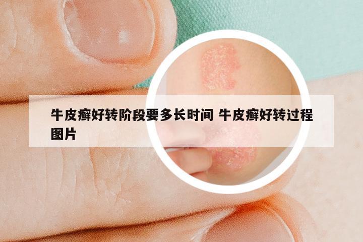 牛皮癣好转阶段要多长时间 牛皮癣好转过程图片