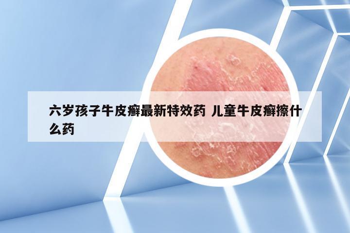 六岁孩子牛皮癣最新特效药 儿童牛皮癣擦什么药