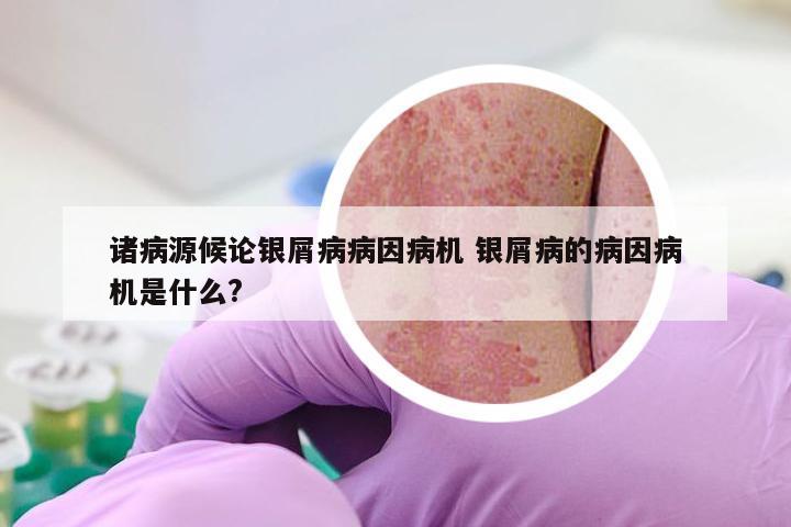 诸病源候论银屑病病因病机 银屑病的病因病机是什么?