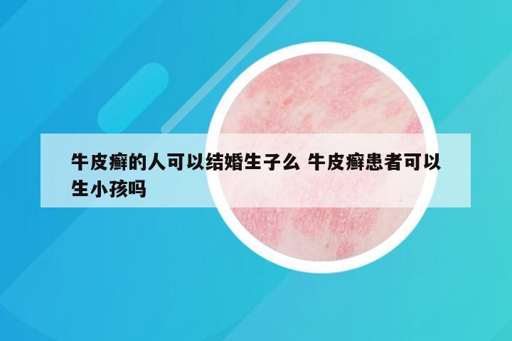 牛皮癣的人可以结婚生子么 牛皮癣患者可以生小孩吗