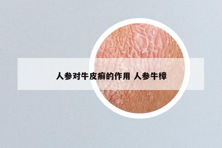 人参对牛皮癣的作用 人参牛樟