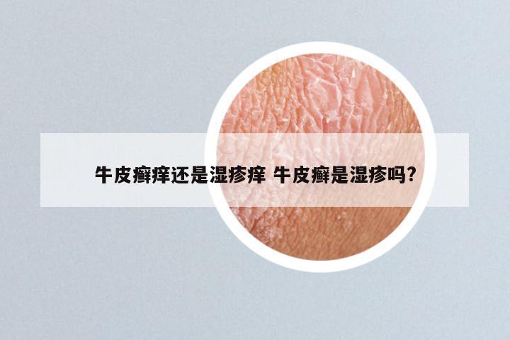 牛皮癣痒还是湿疹痒 牛皮癣是湿疹吗?