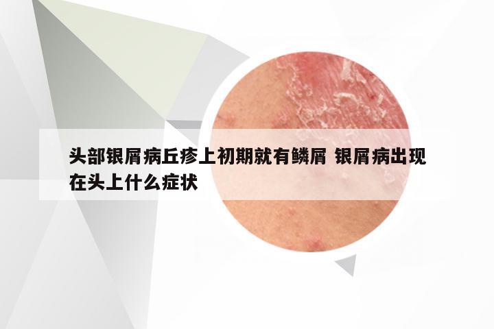 头部银屑病丘疹上初期就有鳞屑 银屑病出现在头上什么症状