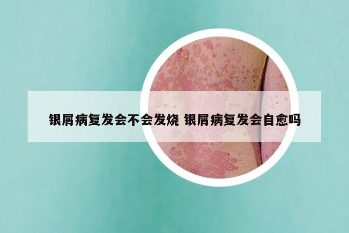 银屑病复发会不会发烧 银屑病复发会自愈吗