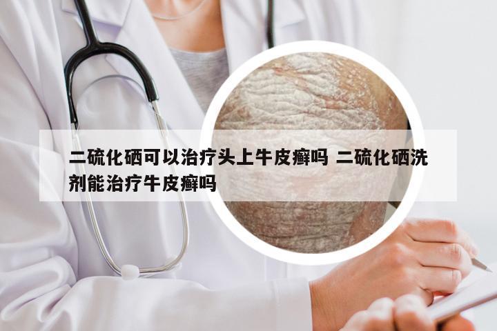 二硫化硒可以治疗头上牛皮癣吗 二硫化硒洗剂能治疗牛皮癣吗