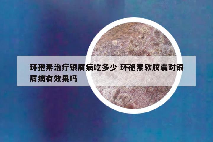 环孢素治疗银屑病吃多少 环孢素软胶囊对银屑病有效果吗
