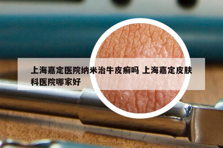 上海嘉定医院纳米治牛皮癣吗 上海嘉定皮肤科医院哪家好