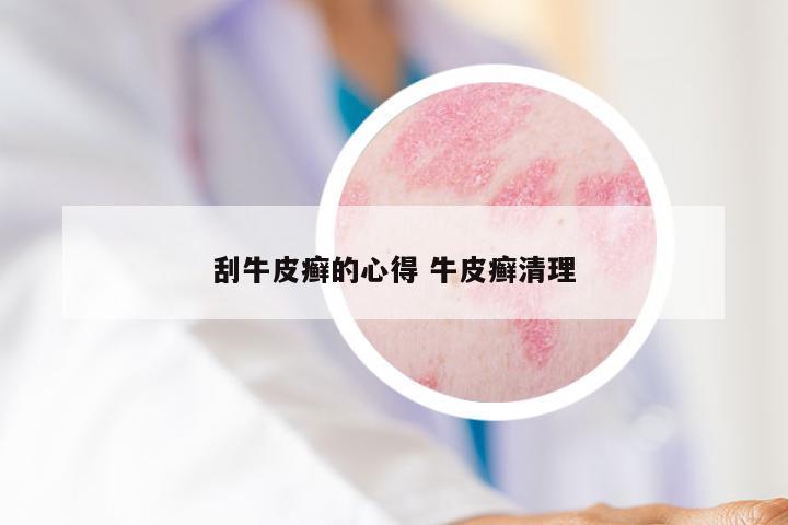 刮牛皮癣的心得 牛皮癣清理