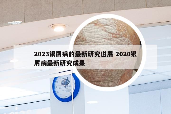 2023银屑病的最新研究进展 2020银屑病最新研究成果