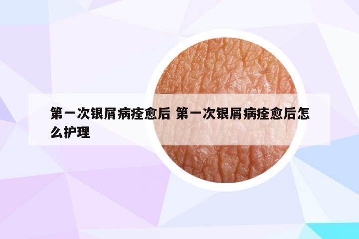 第一次银屑病痊愈后 第一次银屑病痊愈后怎么护理