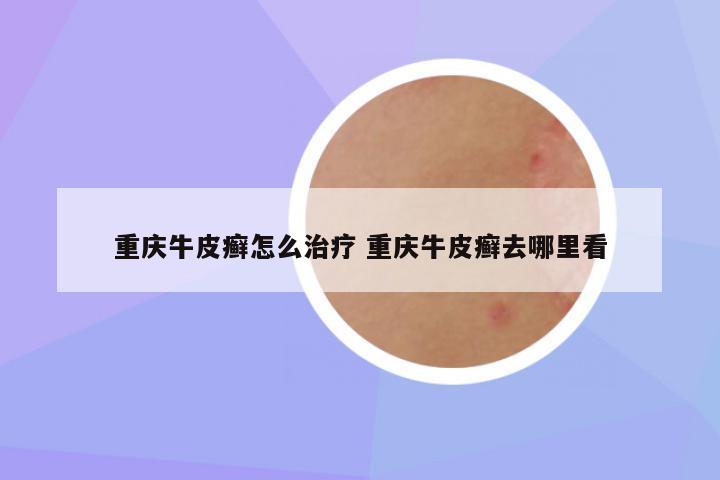 重庆牛皮癣怎么治疗 重庆牛皮癣去哪里看