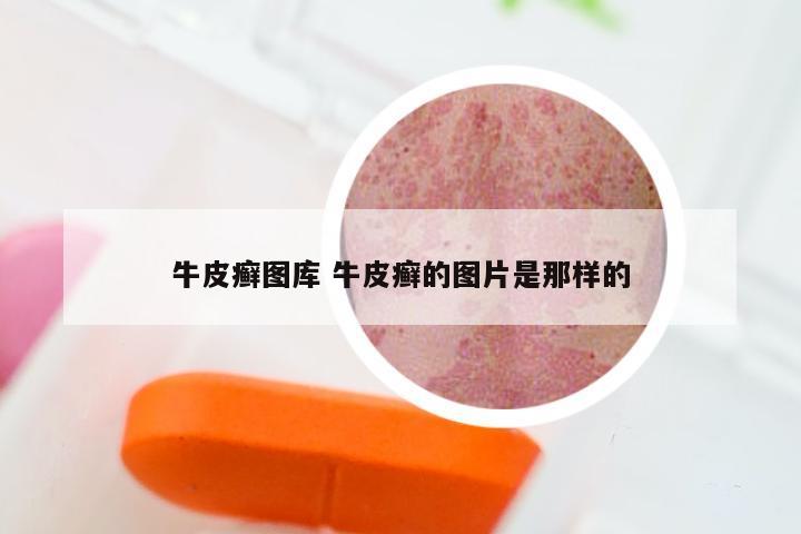 牛皮癣图库 牛皮癣的图片是那样的