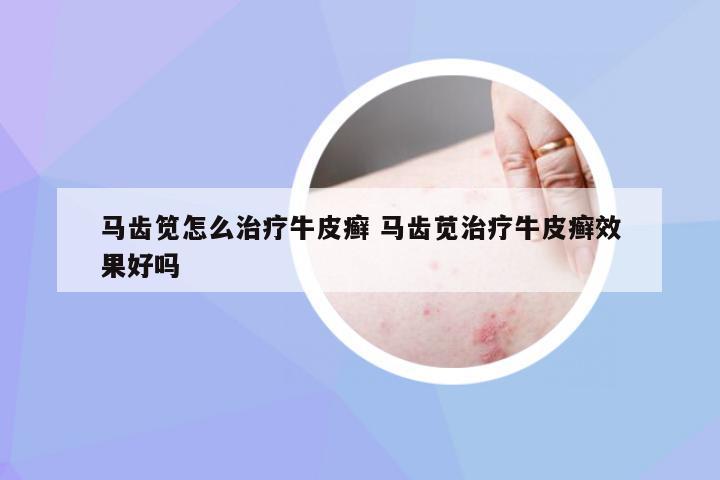 马齿笕怎么治疗牛皮癣 马齿苋治疗牛皮癣效果好吗