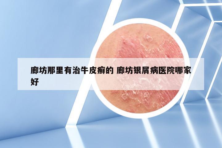 廊坊那里有治牛皮癣的 廊坊银屑病医院哪家好