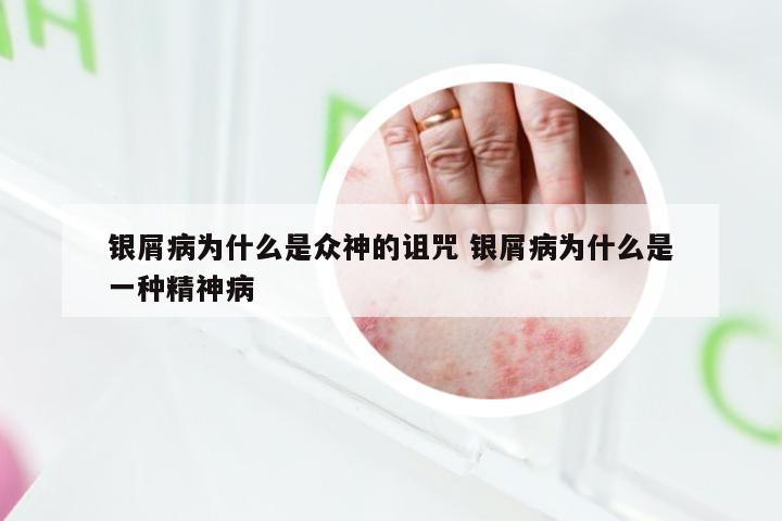 银屑病为什么是众神的诅咒 银屑病为什么是一种精神病