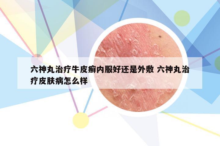 六神丸治疗牛皮癣内服好还是外敷 六神丸治疗皮肤病怎么样