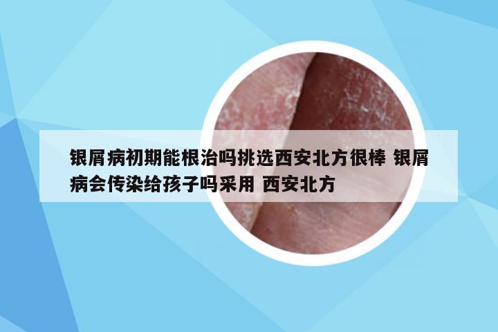 银屑病初期能根治吗挑选西安北方很棒 银屑病会传染给孩子吗采用 西安北方