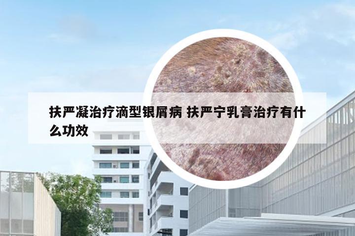 扶严凝治疗滴型银屑病 扶严宁乳膏治疗有什么功效