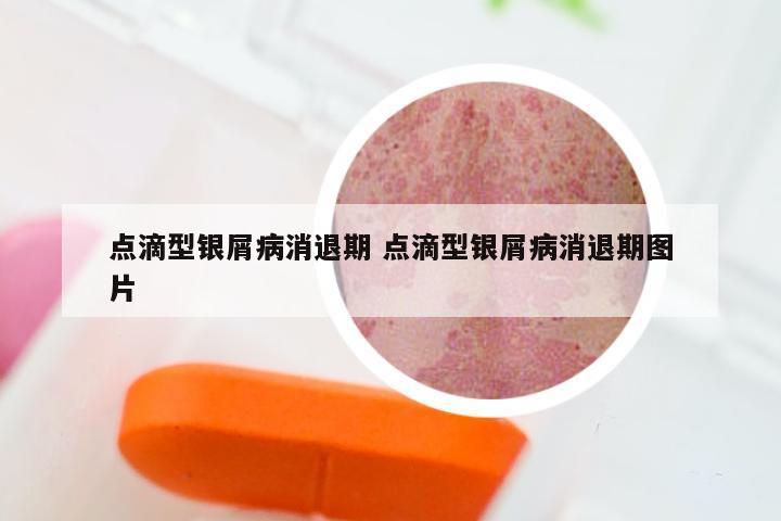 点滴型银屑病消退期 点滴型银屑病消退期图片