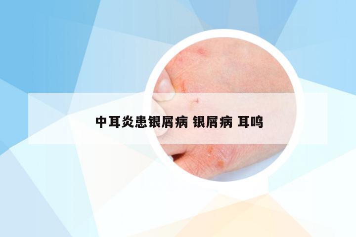 中耳炎患银屑病 银屑病 耳鸣