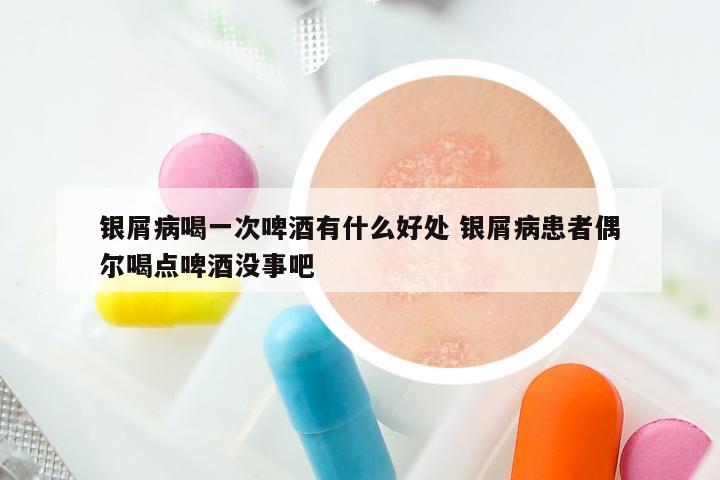 银屑病喝一次啤酒有什么好处 银屑病患者偶尔喝点啤酒没事吧